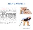 CanapÃ© RÃ©sine TressÃ©e Luxe How to Recover From Arthritis In Physiotherapy